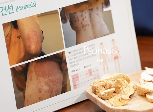 생기한의원 건선 페이지, 피부 병변 감별이 필요한 이유 안내
